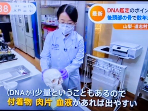 【Nスタ – TBSテレビ】 白骨頭蓋骨からのDNA鑑定